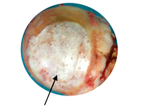 Femoral Head with severely worn cartilage