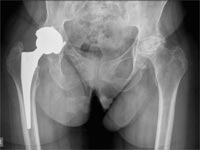 Radiograph showing a replaced hip